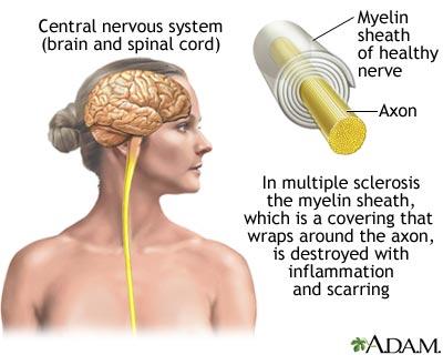 multiplesclerosis.jpg